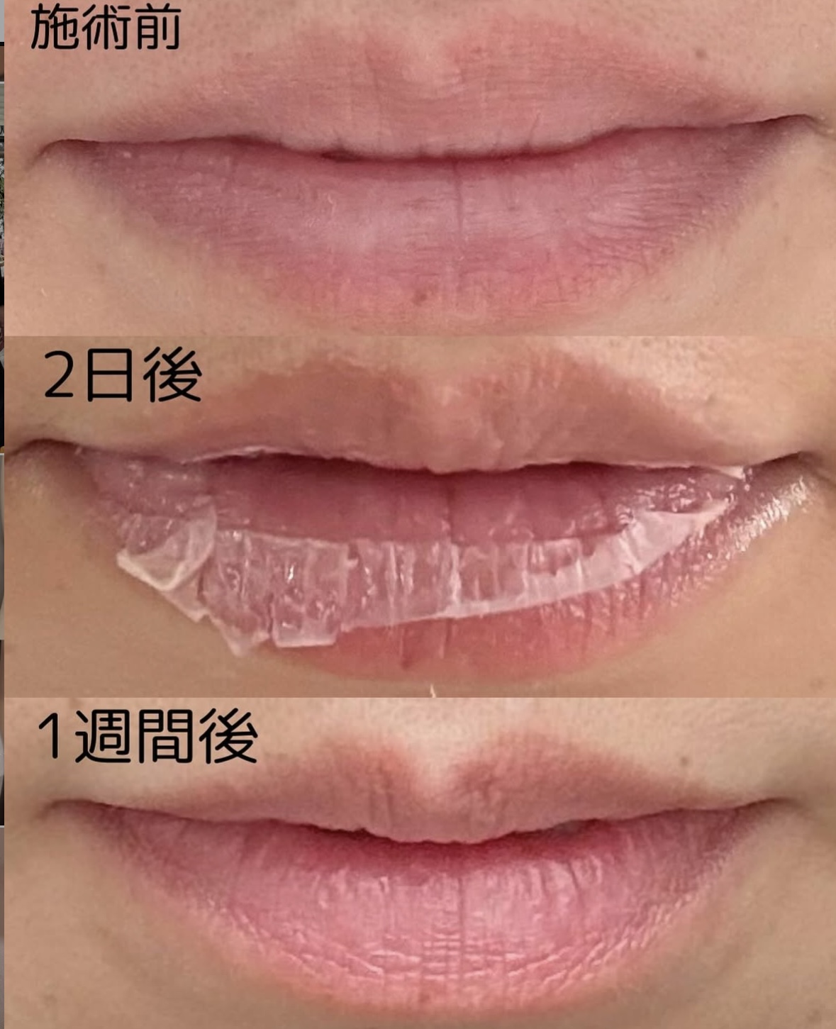 術後の経過　皮むけが終わったらアフタークリーム開始します‼️の画像